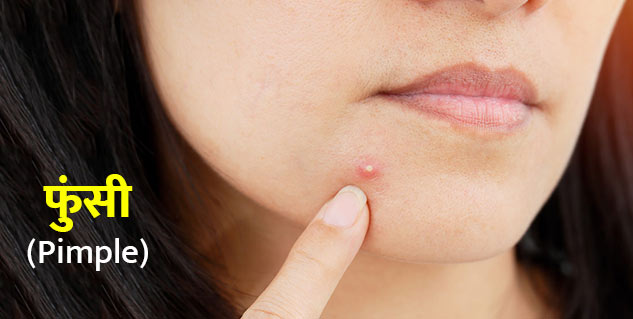 pimple cause and prevention tips