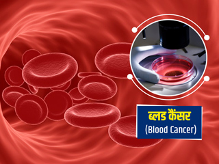 ब्लड कैंसर (Blood Cancer) के लक्षण, कारण, जांच और इलाज के तरीके