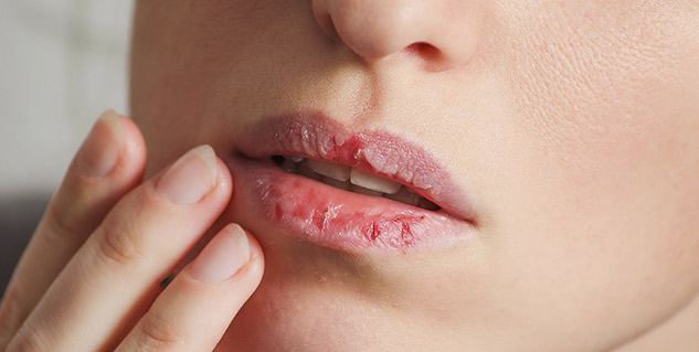 Dry Lips