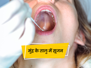 मुंह के ऊपरी हिस्‍से (तालु) में सूजन के हो सकते हैं ये 5 कारण, जानें बचाव के उपाय