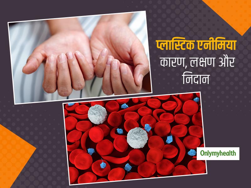 खून की कमी से जुड़ी गंभीर बीमारी है अप्लास्टिक एनीमिया, जानें इस बीमारी के कारण, लक्षण और इलाज