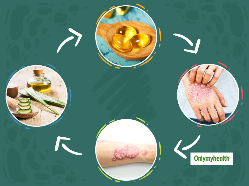 Psoriasis: Try These 9 Home Remedies To Treat This Skin Condition