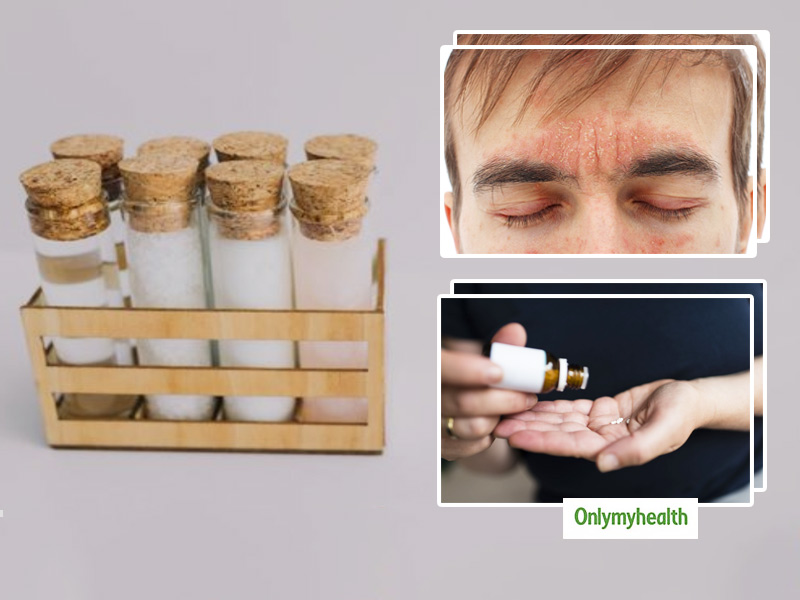 Seborrheic Dermatitis: 10 Homeopathic Remedies To Treat This Common Skin Disease