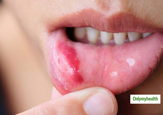 itchy-gums-causes-treatment-and-prevention-from-an-expert-onlymyhealth