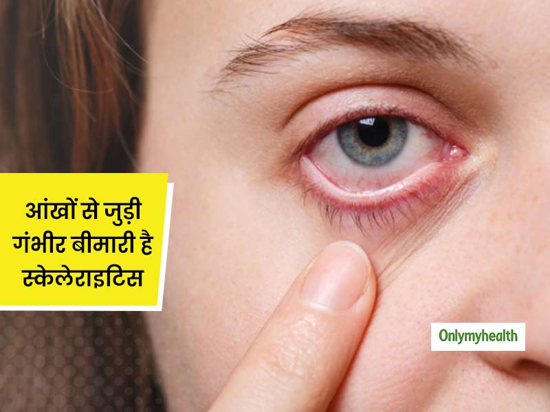 आंखों की ऊपरी पर्त में सूजन और लालपन हो सकता है स्केलेराइटिस का संकेत, जानें इस बीमारी का लक्षण कारण और इलाज