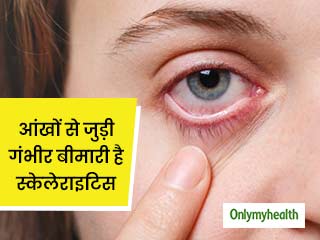 आंखों की ऊपरी पर्त में सूजन और लालपन हो सकता है स्केलेराइटिस का संकेत, जानें इस बीमारी का लक्षण कारण और इलाज