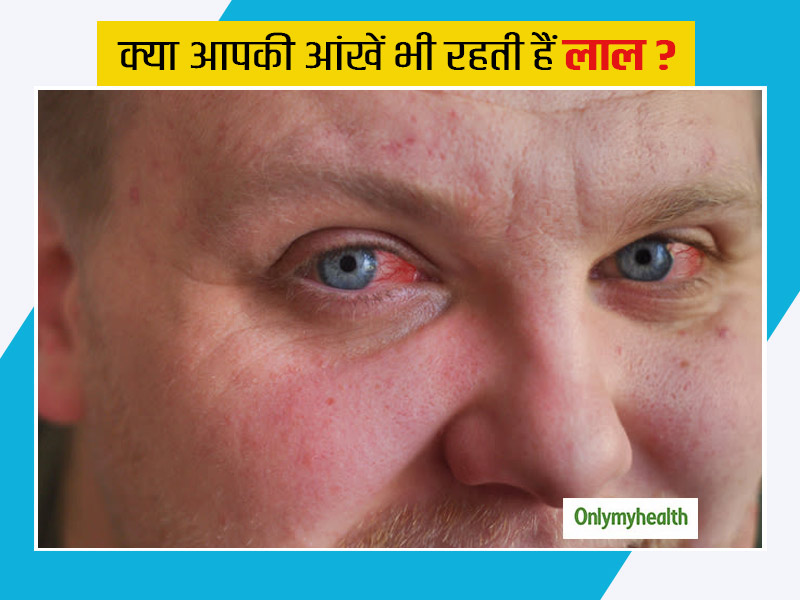 आंखें लाल होने के हो सकते हैं ये 5 कारण, जानें इनसे छुटकारा पाने और आंखों की देखभाल के लिए जरूरी टिप्स