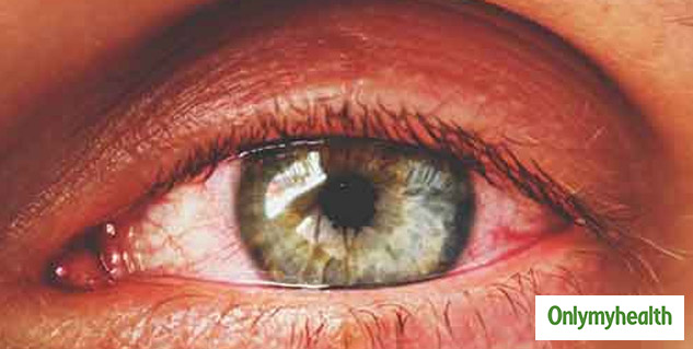 5 Common Causes Of Red Eyes And Important Eye Care Tips In Hindi आ ख ल ल ह न क ह सकत ह य 5 क रण ज न इनस छ टक र प न और आ ख क द खभ ल