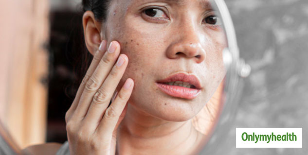 freckle on face