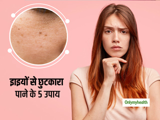 चेहरे की झाइयों से जल्द पाना है छुटकारा, तो अपनाएं ये 5 असरदार घरेलू उपाय