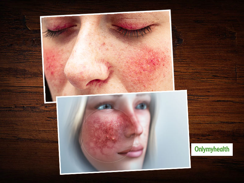 rosacea cheeks treatment