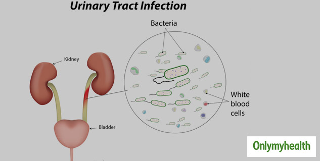 Urinary Tract Infection In Pregnancy: Know Causes, Symptoms and Prevention  Tips