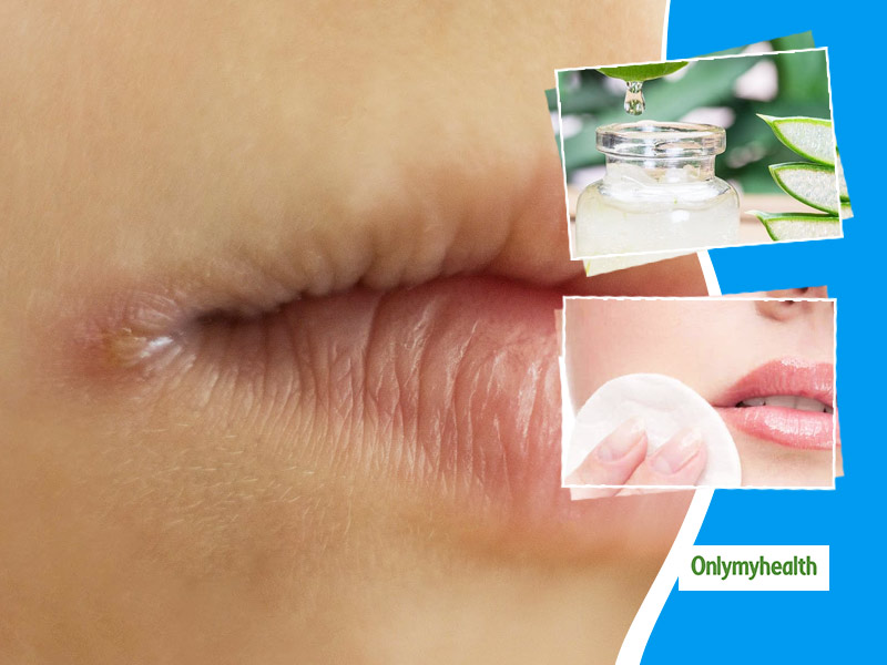 Some Effective Home Remedies For Cracked Mouth Corners Onlymyhealth