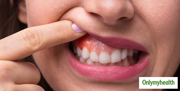 Gum diseases due to tobacco