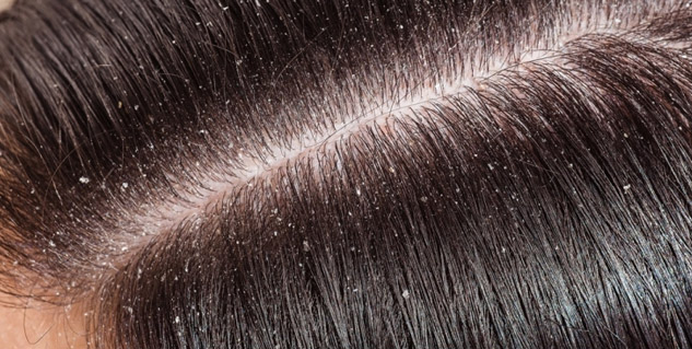 Dandruff_between_the_hairs