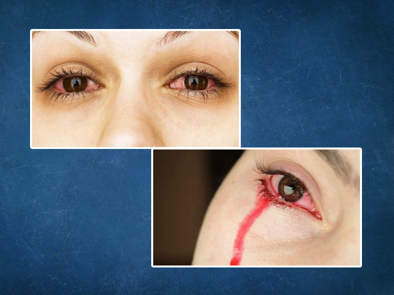 Bloody Tears During Periods, A Rare But Possible Condition | OnlyMyHealth