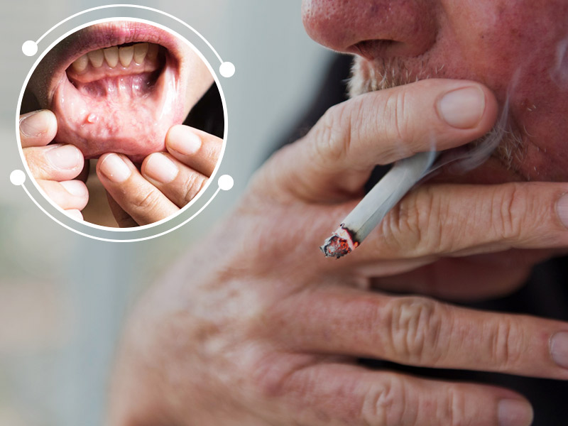 world-oral-health-day-2021-how-tobacco-causes-oral-cancer-onlymyhealth