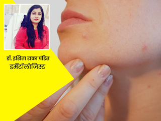 मुहांसे, डार्क सर्कल जैसी समस्याएं हैं हार्मोन में परिवर्तन का संकेत, डर्मेटॉलोजिस्ट से जानें कारण और बचाव