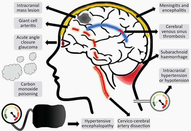 Do You Constantly Have A Headache Know The Different Kinds Signs