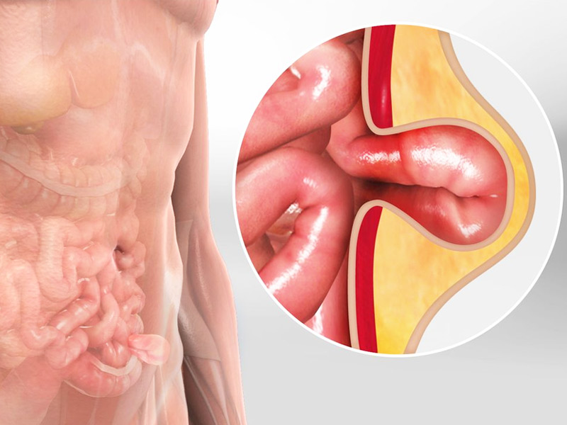 Umbilical hernia: Causes, Symptoms, and Treatments - Rela Hospital