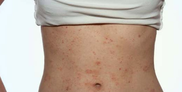 Rashes_caused_by_wearing_bodyshapers