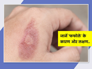 Blisters/Fafola: फफोले के पीछे होते हैं ये 12 कारण, जानें लक्षण और बचाव