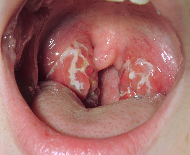 throat