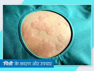 Hives Causes: क्या हैं पित्ती उछलने के 8 कारण? साथ ही लक्षण और बचाव भी जानें