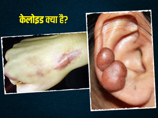इन 5 घरेलू उपायों से केलोइड की समस्या करें दूर, जानिए इसके लक्षण, कारण और बचाव के तरीके