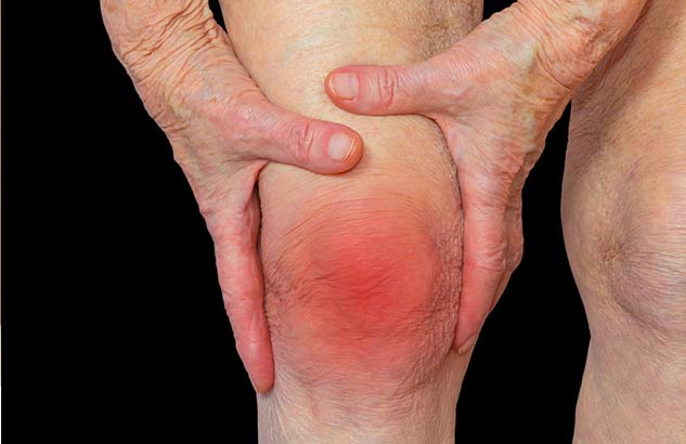 arthritis
