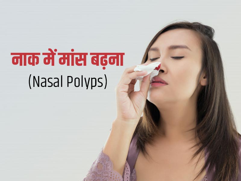 Nasal Polyps Causes: नाक में मांस बढ़ने पर दिखाई देते हैं ये 10 लक्षण, जानें कारण और उपचार