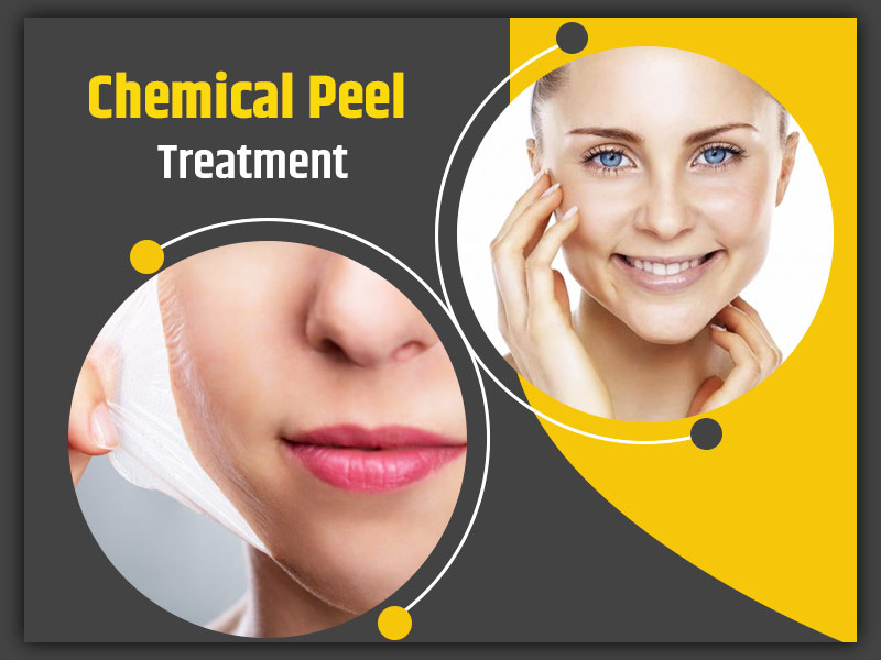 A Guide to Chemical Peel Treatment: Safety, Procedure, Precautions Explained