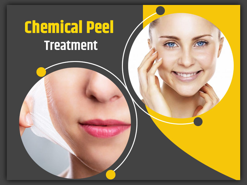 chemical peel burn treatment