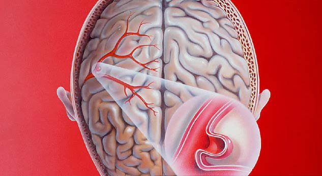 brain aneurism