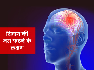 मस्तिष्क एन्यूरिज्म (धमनी विस्फार) के क्या होते हैं लक्षण, जानें कब होता है खतरनाक
