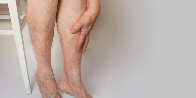 Inside3VaricoseVeins