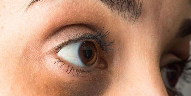 dark circles 