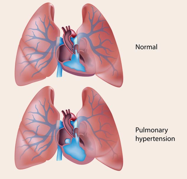 inside1pulmonaryhypertension