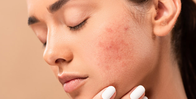pimples