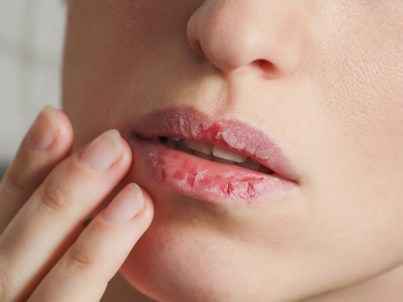 Cracked Lip Corner: होठों के कोनों के फटने पर आजमाएं ये 5 घरेलू उपाय