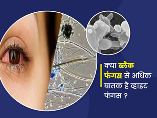 क्या व्हाइट फंगस सच में ब्लैक फंगस से ज्यादा खतरनाक है? जानें क्या कहते हैं डॉक्टर्स