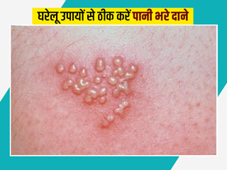  त्वचा पर पानी भरे दाने (हर्पीस) के लिए 7 घरेलू नुस्खे
