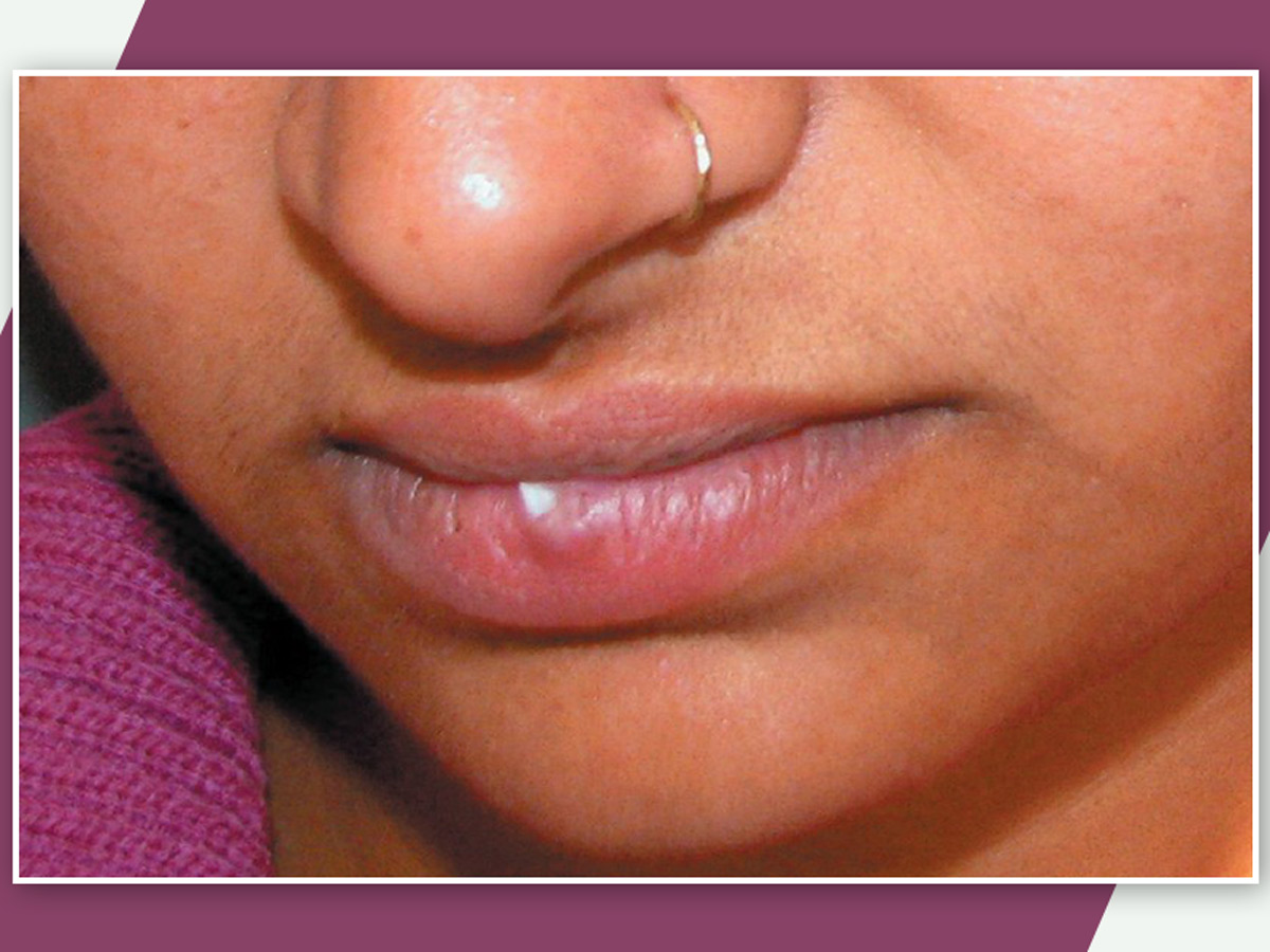 White Spots On Lips Treatment In Hindi