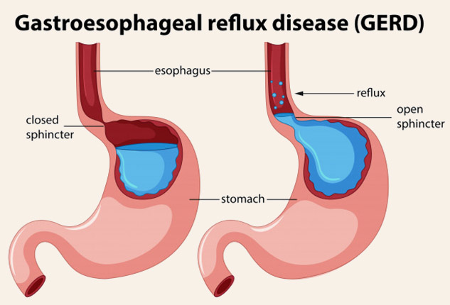 gerd disease