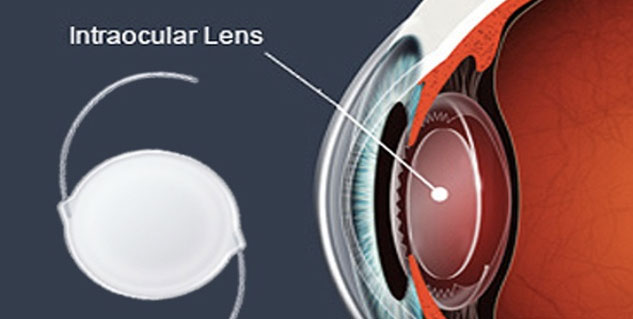 false lens in eyes
