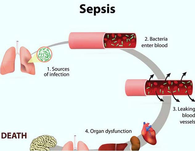 Sepsis Infection: Symptoms, Causes and Risk Involved | OnlyMyHealth