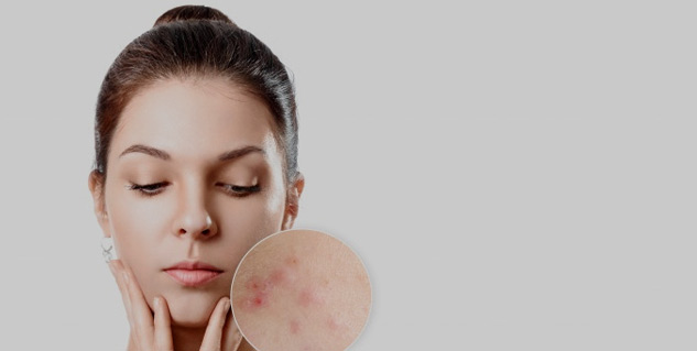 Inside2acne