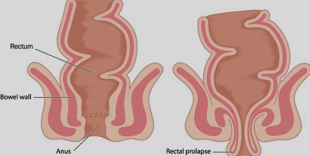 Insiderectalprolapse