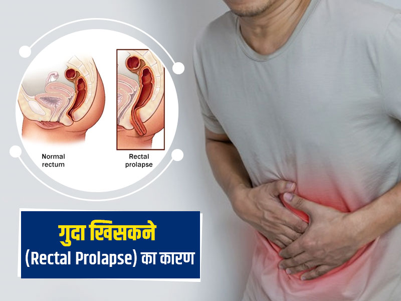 Rectal prolapse: 50 के बाद महिलाओं में ज्यादा होता है गुदा (मलद्वार) बाहर आने का खतरा, जानें क्या है ये बीमारी