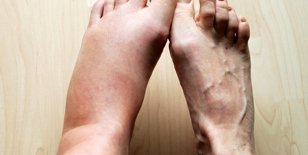 swelling in leg